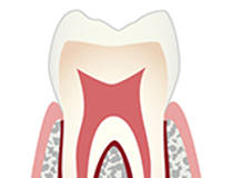 「C0」虫歯になる前