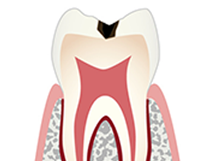 「C1」エナメル質までの虫歯進行