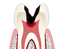 「C3」歯髄まで虫歯進行