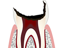 「C4」歯根まで虫歯進行