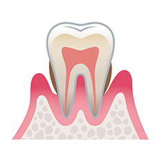 歯周病